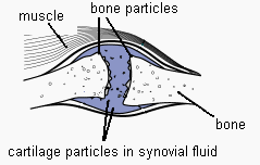 arthritis