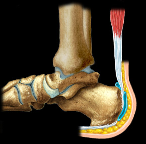 bursita retrocalcaneana)