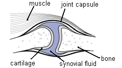 osteoarthritis